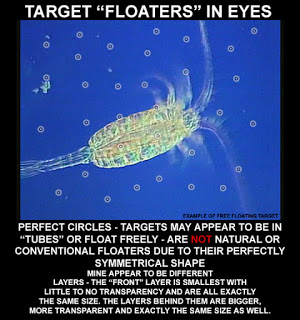 Target Nano floaters in eye fluid