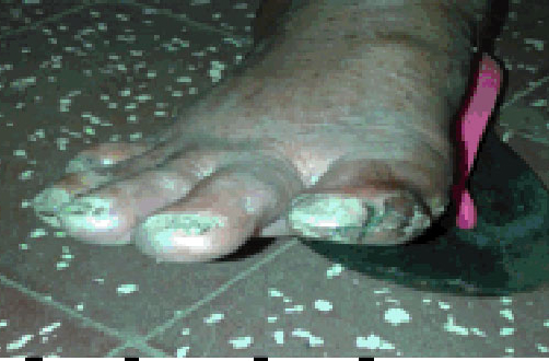 Diabetic feet infected