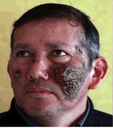 Ecuador man with severe Pemphigus Vulgaris before MMS