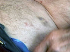 Frank Lasser shows the marks left on his body after being stunned three times by a Taser. 